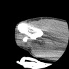 SPORK, NICO - 22.03.1976 - 02.08.2022 - CT obere Extremität - 17:51:17